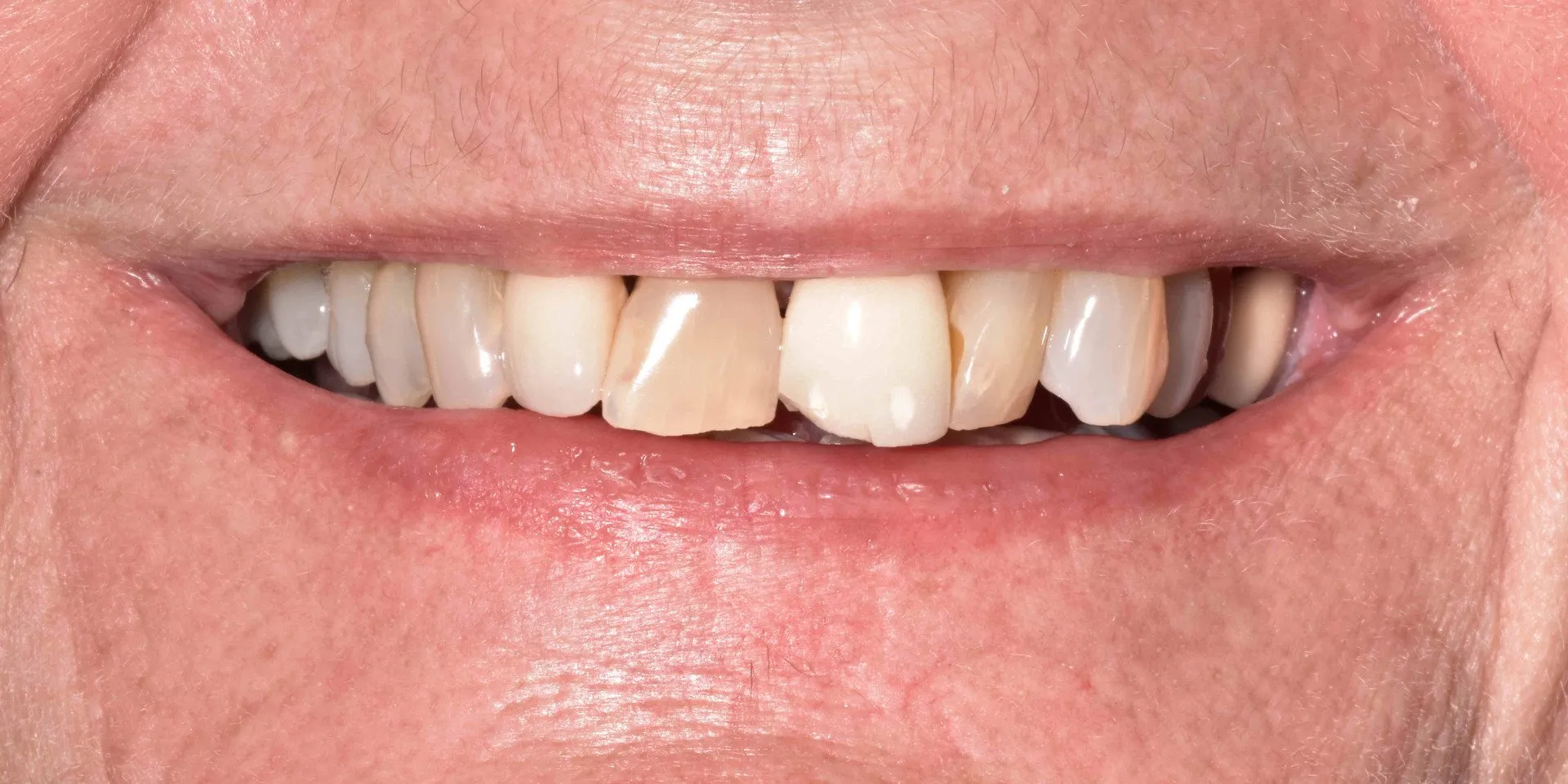 Close-up--pre-op-smile-min-1920w