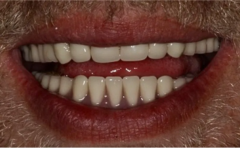 after-all-on-x-min-1920w