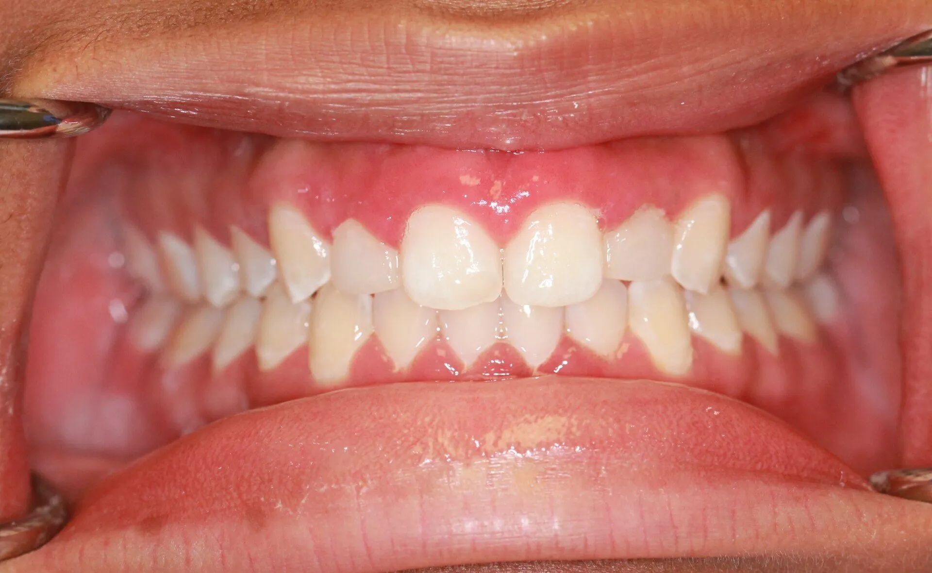 erin-sills-post-op-(MI)-min-1920w