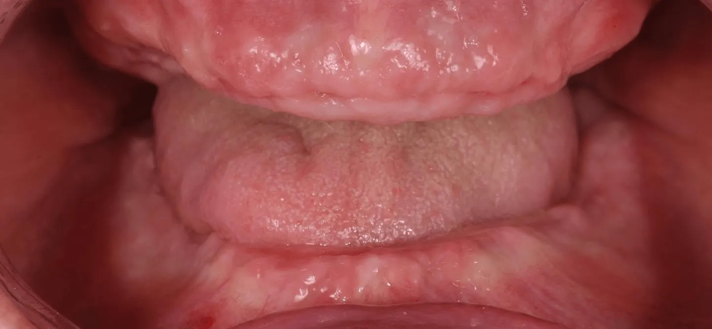 pre-post-dentures-1-min-1920w