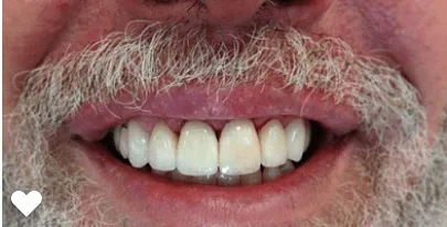 pre-post-veneers-56180bdd-min-1920w