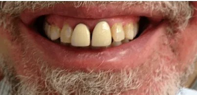 pre-post-veneers-min-1920w